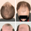 Natural Remedies for Male Pattern Baldness: The Ultimate Guide