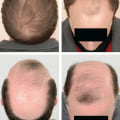 Understanding Hereditary Hair Loss