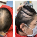 Female Hair Loss: Causes, Risks, and Treatments