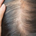 Understanding Iron-Deficiency Anemia and Its Link to Hair Loss