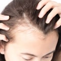 Understanding Female Hair Loss: Causes, Treatments, and Prevention