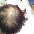 Thyroid Disorders and Hair Loss: What You Need to Know