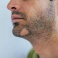 Understanding and Managing Alopecia: A Comprehensive Guide