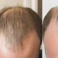 Understanding Genetics and Male Pattern Baldness
