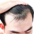 Understanding Stress and Hair Loss