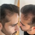 Hair Transplants: Understanding Hair Loss and Treatment Options