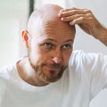 Understanding Male Pattern Baldness and Lifestyle Factors: What You Need to Know