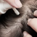 Understanding Minoxidil: A Comprehensive Guide to Preventing Hair Loss