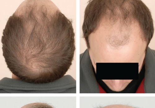 Natural Remedies for Male Pattern Baldness: The Ultimate Guide