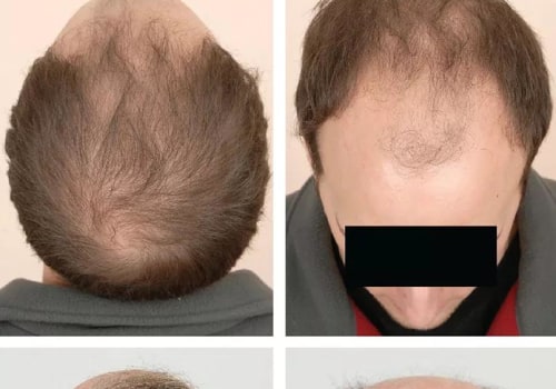 Understanding Hereditary Hair Loss