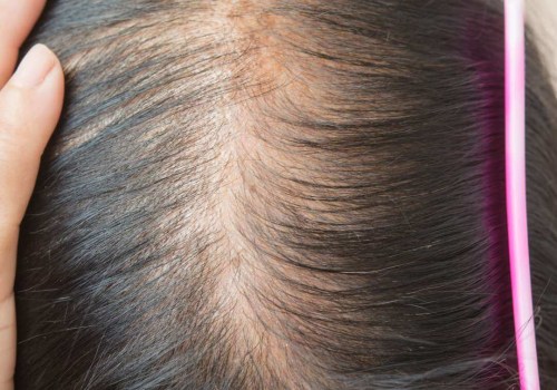 Understanding Iron-Deficiency Anemia and Its Link to Hair Loss