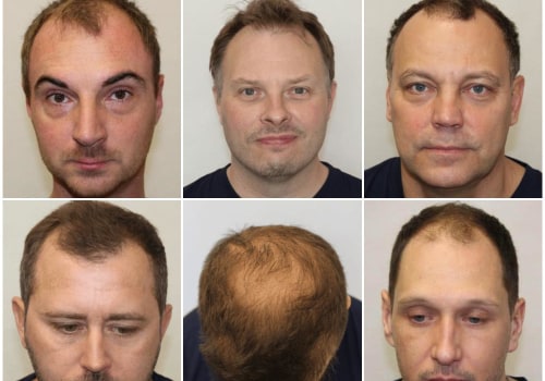 All You Need to Know About Male Pattern Baldness