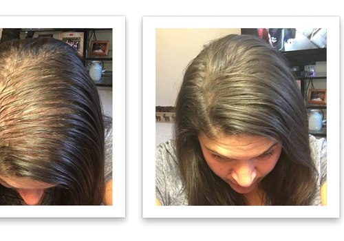 Everything You Need to Know About Scalp Concealers for Hair Loss Prevention