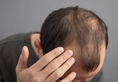 Stress Management for Hair Health: A Comprehensive Guide for Preventing Baldness and Promoting Hair Regrowth