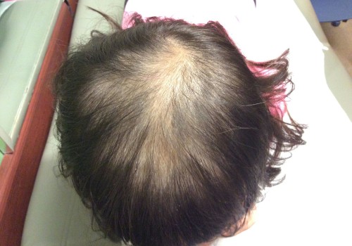Thyroid Disorders and Hair Loss: What You Need to Know