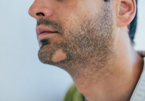 Understanding and Managing Alopecia: A Comprehensive Guide