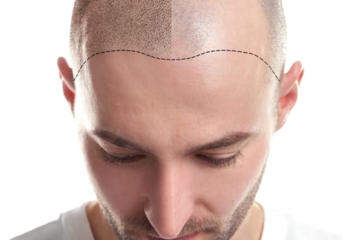 Understanding Scalp Camouflage Techniques for Preventing Baldness and Hair Loss