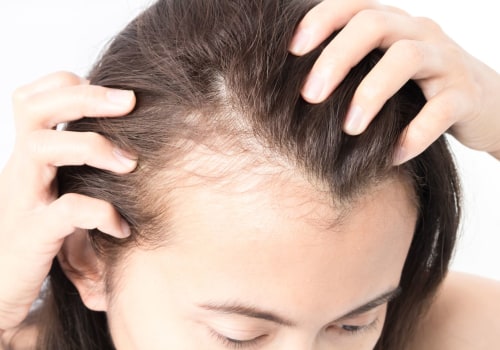 Medical Treatments for Female Hair Loss: Understanding the Causes and Solutions