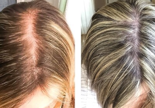 Wigs and Hairpieces: Understanding Hair Loss and Finding Solutions