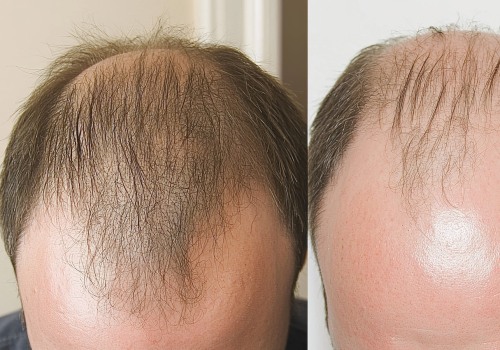 Understanding Genetics and Male Pattern Baldness