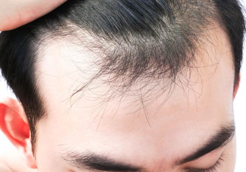 Understanding Stress and Hair Loss