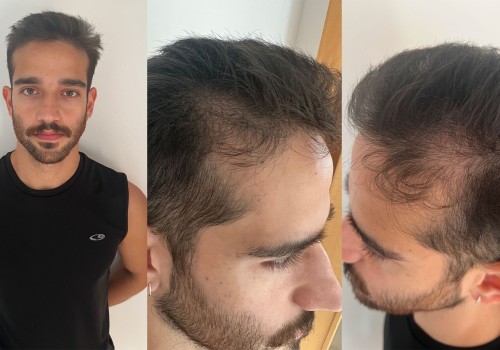 Hair Transplants: Understanding Hair Loss and Treatment Options