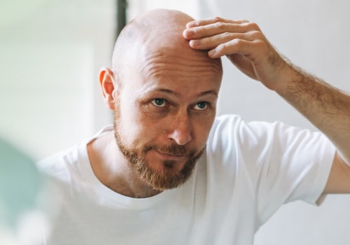 Understanding Male Pattern Baldness and Lifestyle Factors: What You Need to Know
