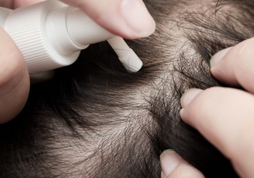 Understanding Minoxidil: A Comprehensive Guide to Preventing Hair Loss